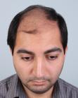 Before Hair Transplant&nbsp;Front